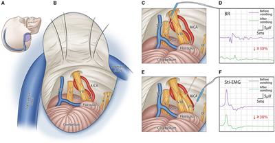 Management of Meige syndrome with bilateral trigeminal and facial nerves combing